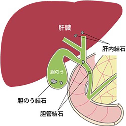 胆管結石イメージ