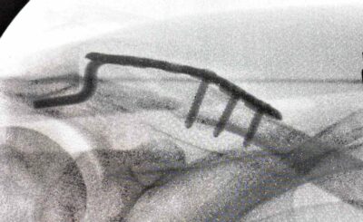 犬の散歩で鎖骨骨折｜麻酔が切れた夜、医師が患者として知った“本当の痛み”【実録・第4話】のアイキャッチ画像