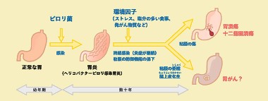 胃がんイメージ